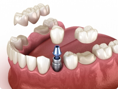 Animated smile comparing dental implants to fixed bridges