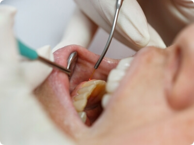 Closeup of smile during laser scaling and root planing treatment
