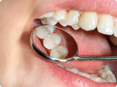 Closeup of smile after dental sealants are placed