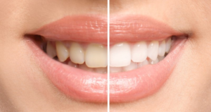 a before and after comparison of a whitened smile